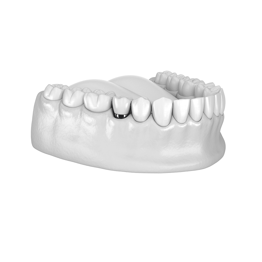 Happidents illustration av ett implantat som ersätter en tand